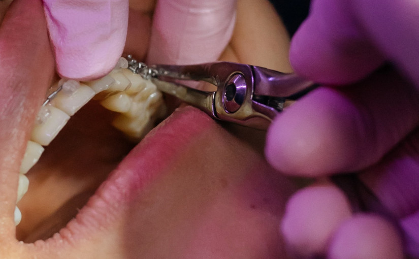 牙醫濫拔牙齒被指專業失德 判停牌1年罰款1萬