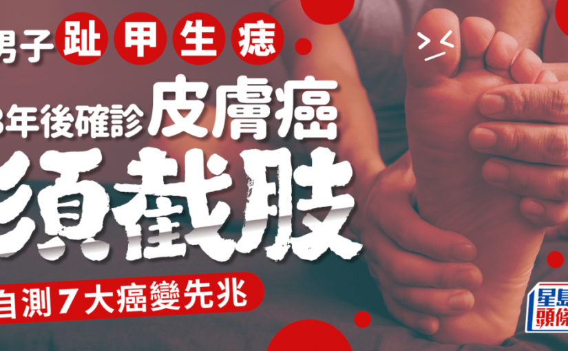 男子腳趾甲生痣 3年後確診皮膚癌截肢 自測黑痣7大癌變先兆