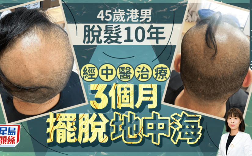 45歲港男脫髮10年 中醫治療3個月擺脫地中海 附生髮食療
