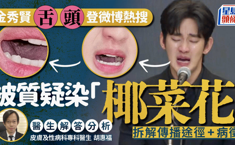 「金秀賢舌頭」登微博熱搜 被質疑染「椰菜花」醫生解答分析 拆解傳播途徑+常見病徵