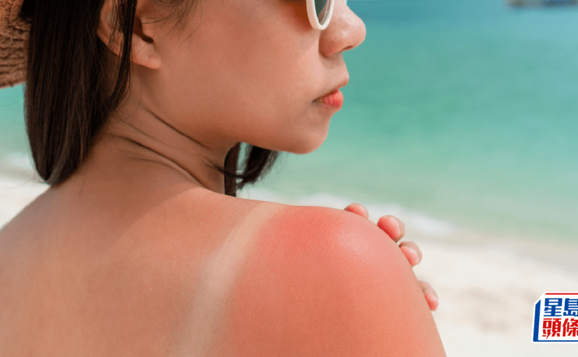 專家教曬傷後6招急救皮膚！塗蘆薈紓緩反增感染風險？保濕消紅腫必選2成分