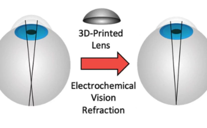科技| 矯視重塑角膜毋須激光電流　新技術或成LASIK替代方案